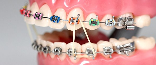 Drronins_Smilezone_Dental_Clinic_Muvattupuzha-coloured-braces