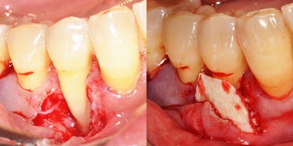 Periodontal regeneration drroninssmilezone.com