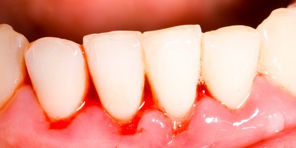 Surgical therapy and periodontal regeneration