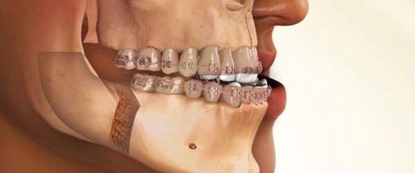 Drronins_Smilezone_Dental_Clinic_Muvattupuzha-surgical-orthodontics