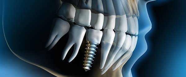 dental implants drroninssmilezone.com
