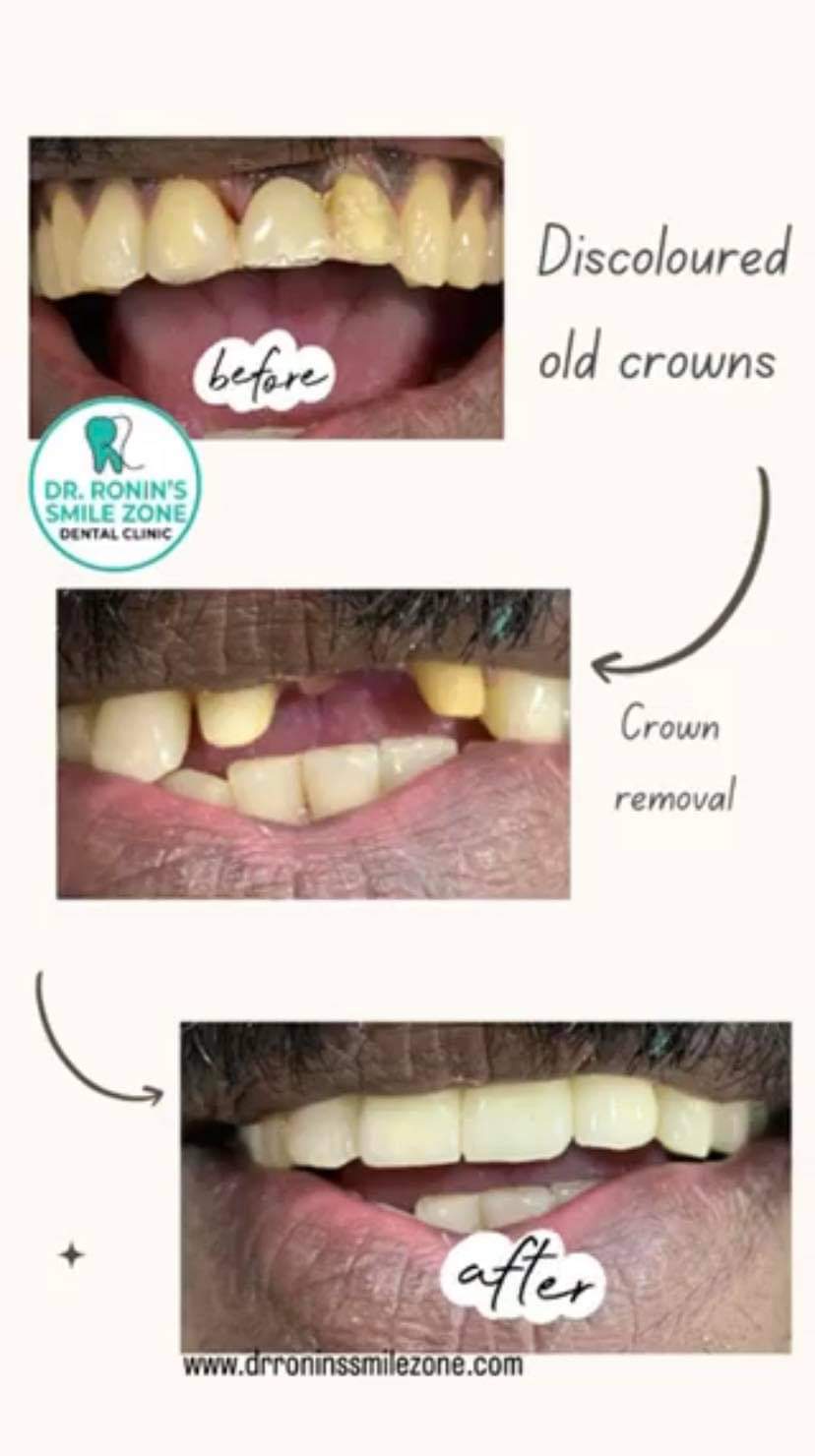 dental procedure before and after